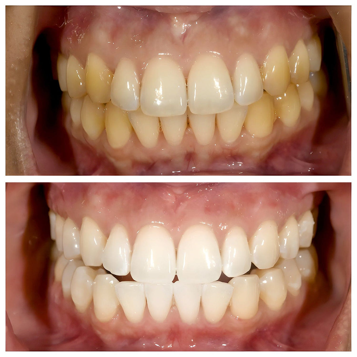 Dentifricio sbiancante alla niacinamide - TriBright